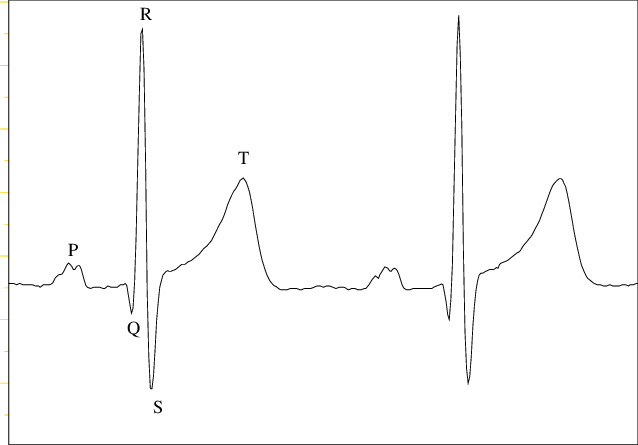 Schéma d'un ECG avec les ondes PQRST